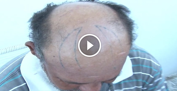 Depois do bandido que foi tatuado, é a vez do marido que teve o chifre tatuado na testa